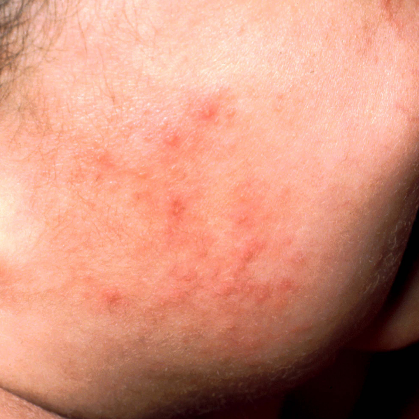 Atopowe zapalenie skóry - wyprysk niemowlęcy na twarzy