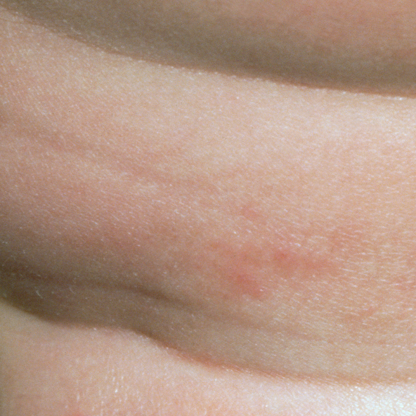 Atopowe zapalenie skóry - wyprysk niemowlęcy