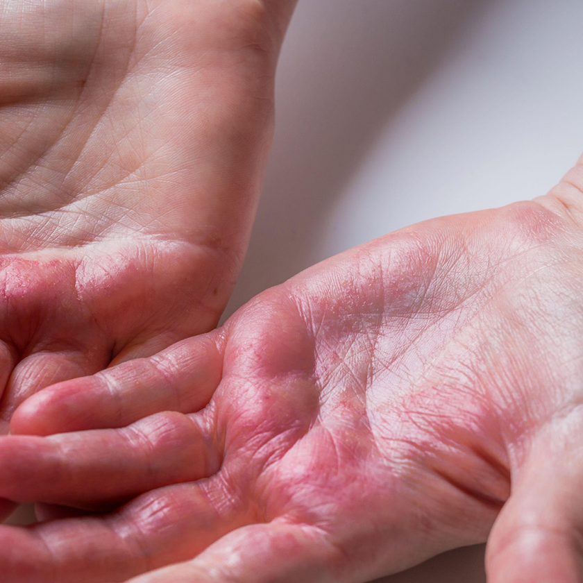 atopowe zapalenie skory dłoni