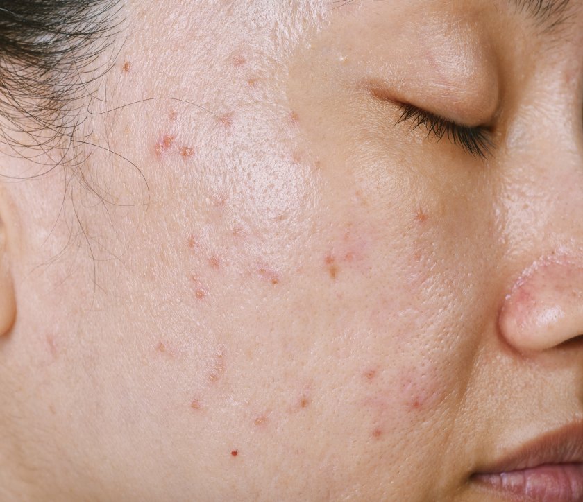 trądzik młodzieńczy