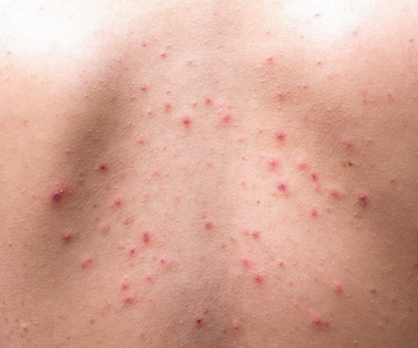 zmiany skórne nastolatków