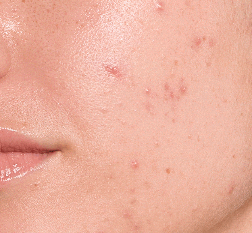 zmiany skórne nastolatków