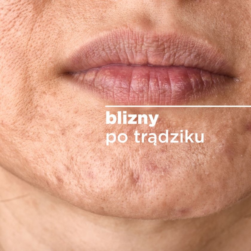 blizny-po-tradziku