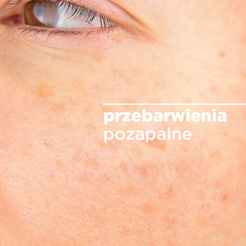 przebarwienia-pozapalne