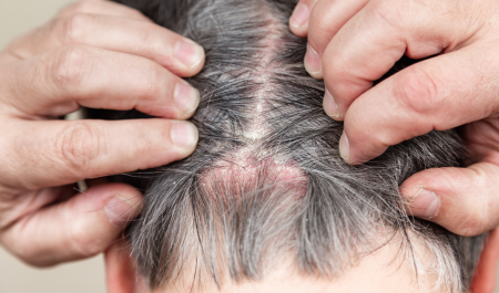 psoriasis on the scalp