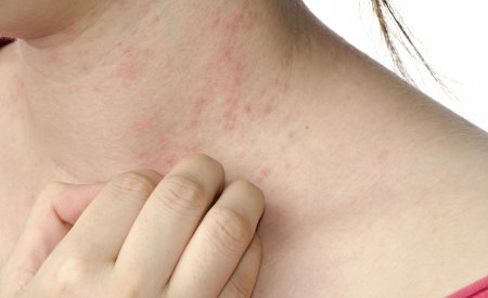 Scratching - Eczema Scratching - Eczema