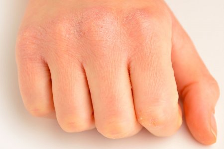 Damaged sensitive skin hands