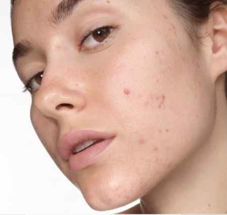 trądzik młodzieńczy SEBIUM