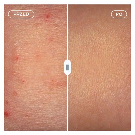 efekt przed i po zastosowaniu balsamu Atoderm AD