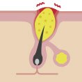 Cutibacterium acnes Cutibacterium acnes