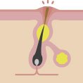 blackhead appearing blackhead appearing