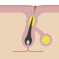 hyperkeratinisation hyperkeratinisation