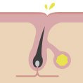 Hyperseborrhea & dysseborrhea