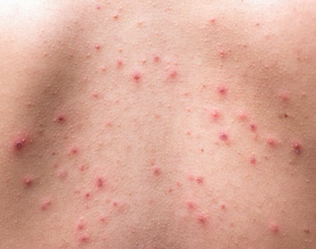 trądzik na plecach zdjęcia