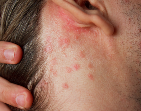 psoriasis behind ear