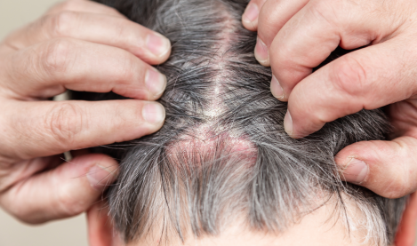 psoriasis on the scalp